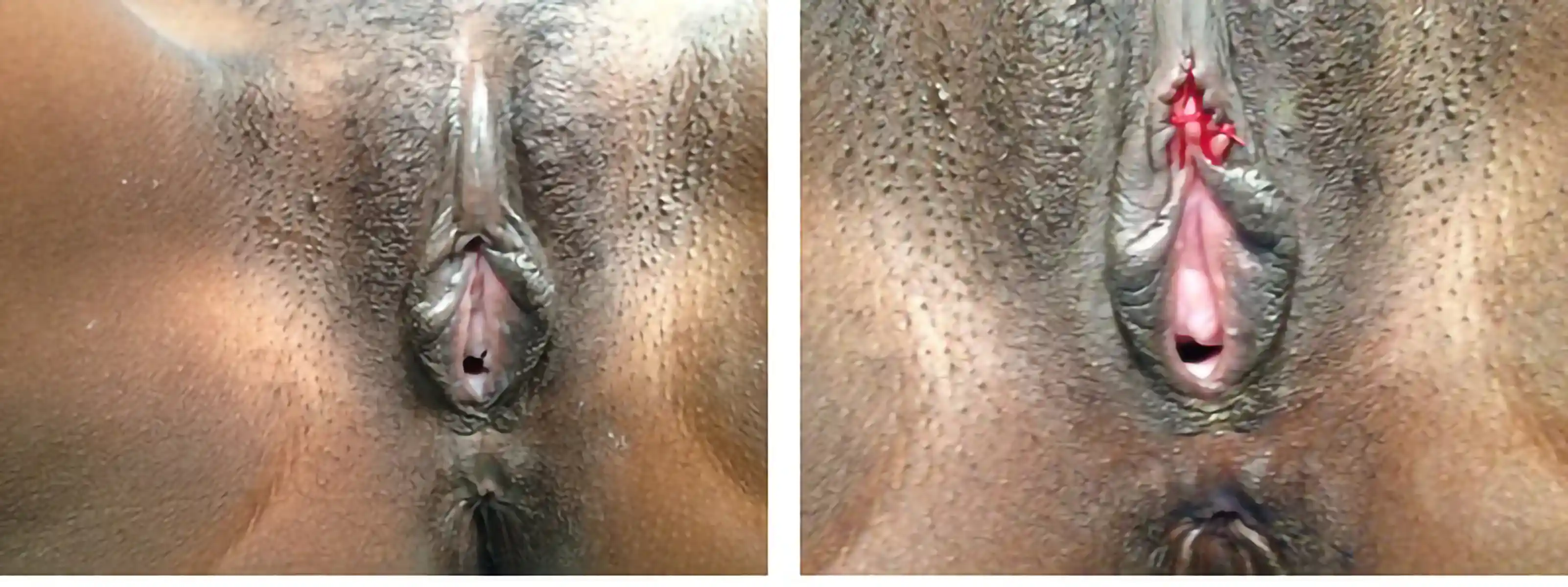 Pre- and postoperative images. Labia minora were largely intact, but the clitoris was concealed by scar tissue, which was removed to restore natural anatomy and appearance.