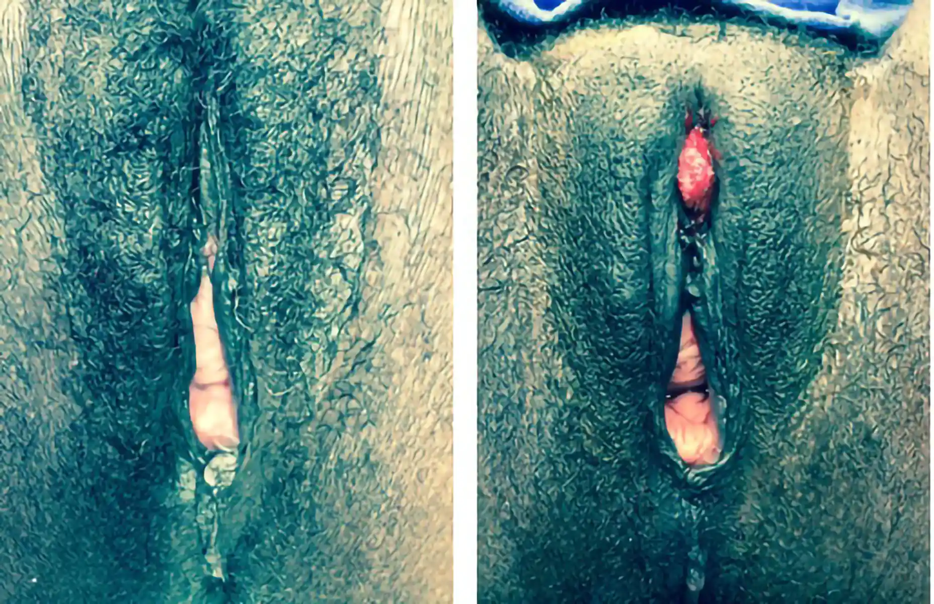 Pre- and postoperative comparison demonstrating successful restoration of external genital structures and improved aesthetic outcome.