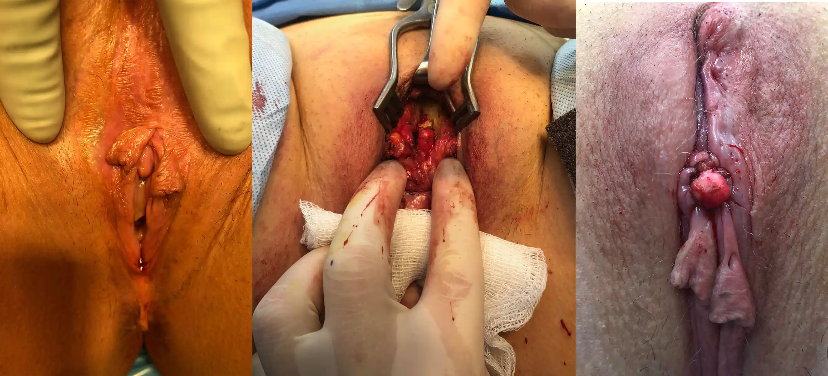 Patient previously underwent clitoral excision for malignancy, resulting in Type 1b FGM. Clitoral Restoration Surgery (CRS) enabled visualization of the full clitoral body (center image), release of the suspensory ligaments, and fixation of the clitoris in a lower, natural position.