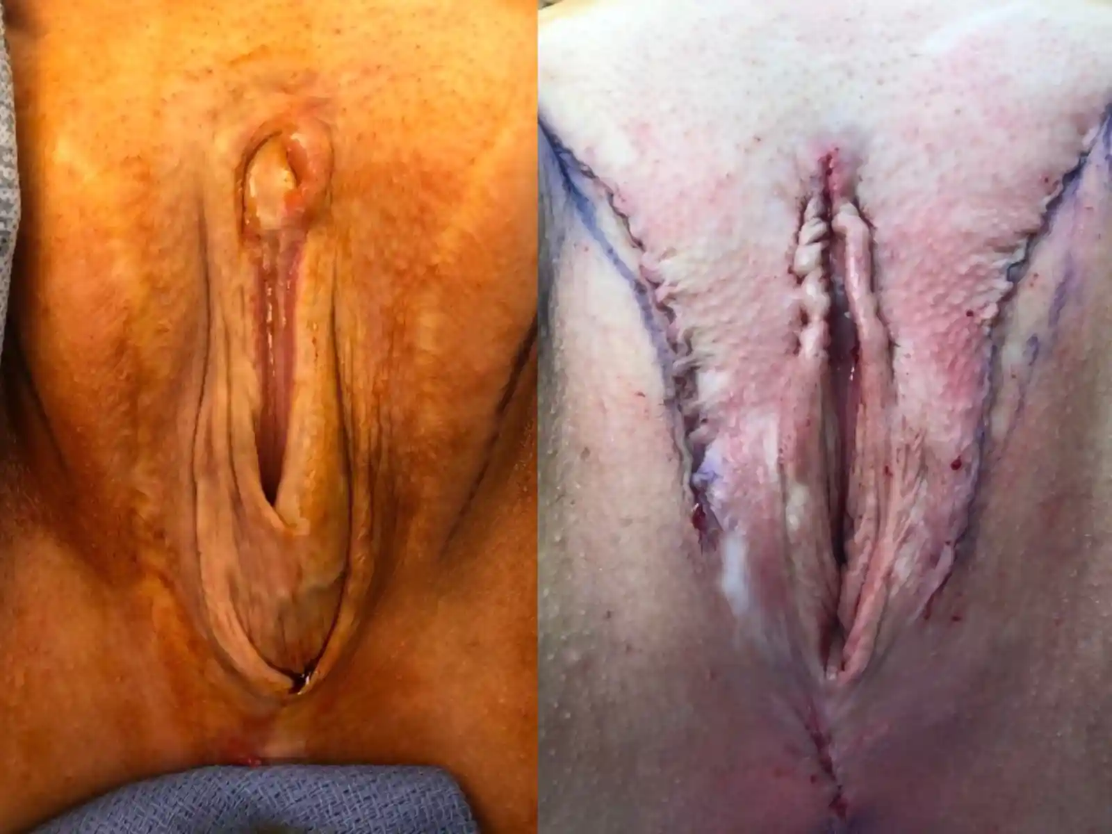 Primary surgery by another provider resulted in multiple complications: graft necrosis, prolapse, abscess, and clitoral malposition. Dr. Bowers’ revisions included labiaplasty, urethroplasty, and excision of the abscess tract to restore structure and comfort.
