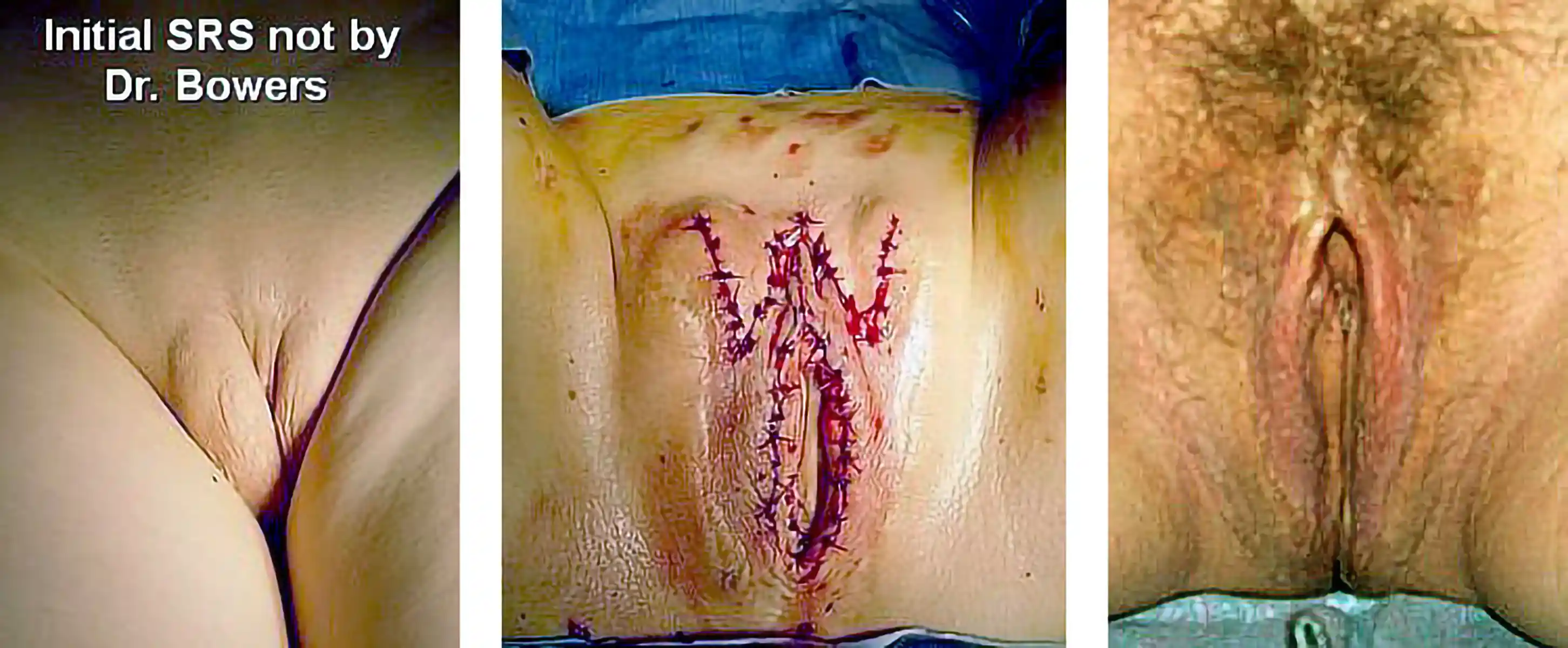 This patient presented with significant asymmetry after surgery by another surgeon. Postoperative results show restored balance, improved symmetry, and refined aesthetics following revision with Dr. Bowers.