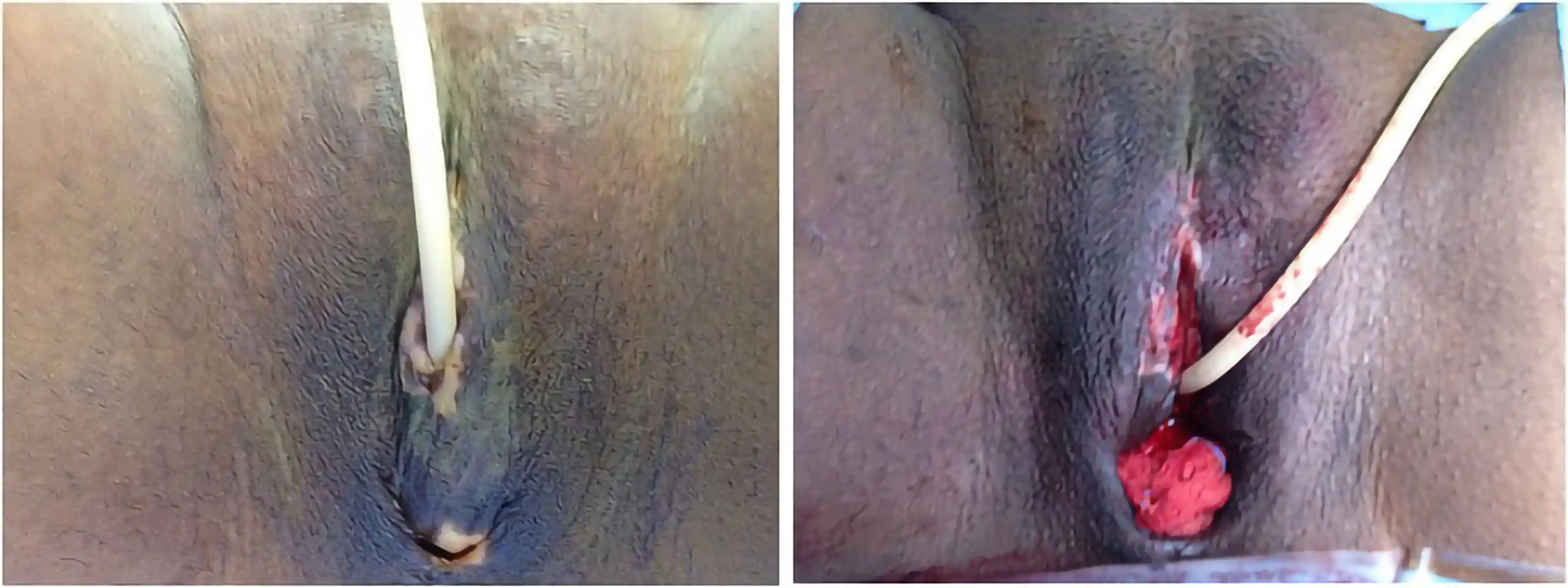 Following complications from a prior surgery, this patient had difficulty with urination due to anterior urethral placement. Dr. Bowers corrected the urethra and created labia minora with proper clitoral hooding for both function and appearance.