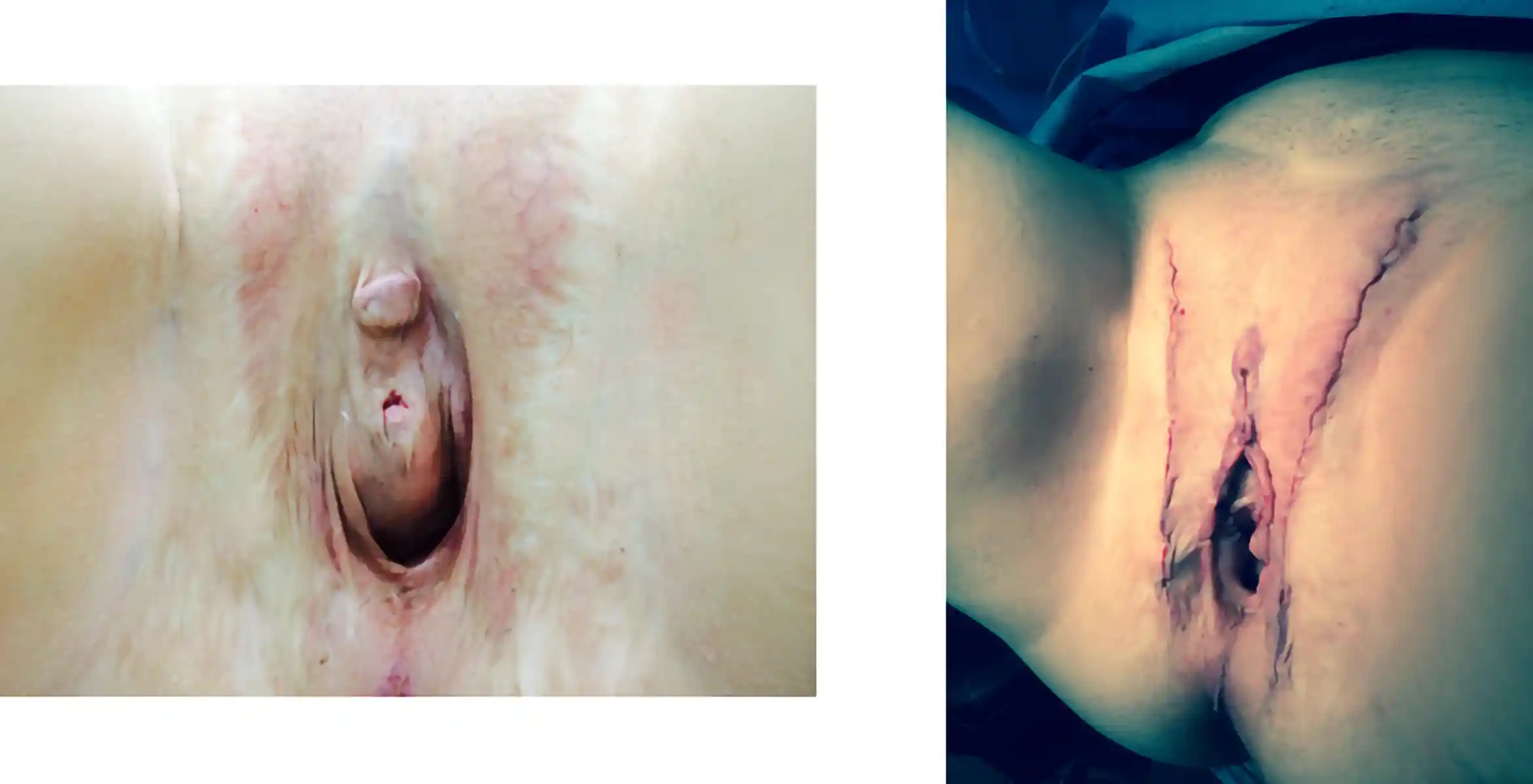 Revision of a previous GAV procedure to address absence of clitoral hood and labia minora. Surgery recreated labial structures, restored hooding, removed anterior erectile tissue, and repositioned the urethra for improved function.