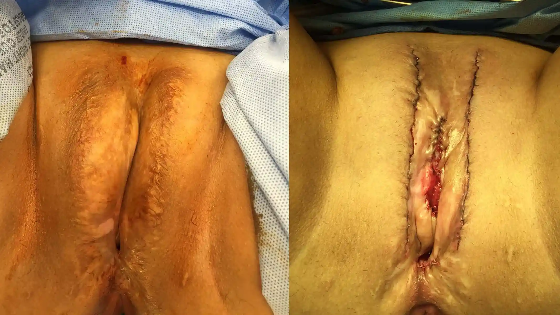 Revision of a prior vaginoplasty with complaints of absent clitoris, deviated urethra, and poor symmetry. Dr. Bowers’ 2016 revision achieved improved balance, contour, and restoration of clitoral anatomy.