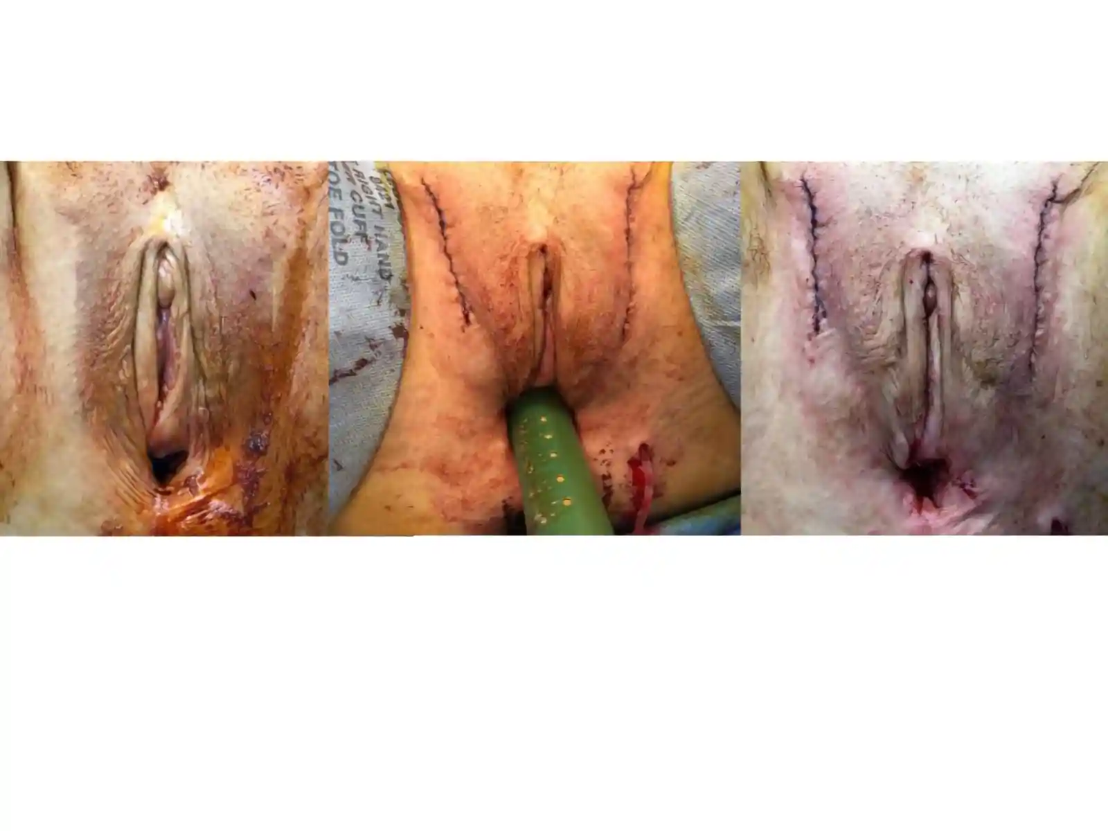 [Left/Center] Prior vaginoplasty plus three labiaplasties and grafting by another surgeon left severe vaginal entry scarring, exposed and anteriorly displaced clitoris, and asymmetry. [Right] Dr. Bowers performed bilateral scar revisions, fat transfers, hoodplasty, and clitoroplasty to restore symmetry and contour while maintaining patient-requested depth.