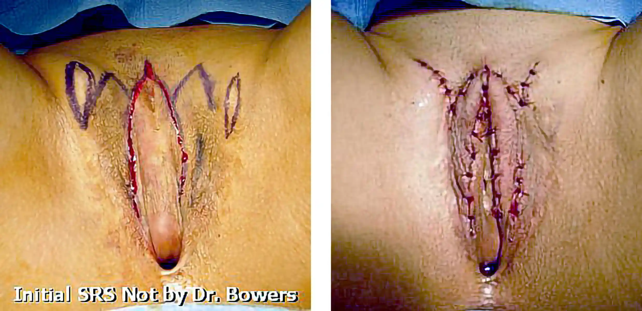 Initial GAV was not performed by Dr. Bowers. Revision included creation of labia minora and improved vaginal framing, enhancing the overall appearance and structure.