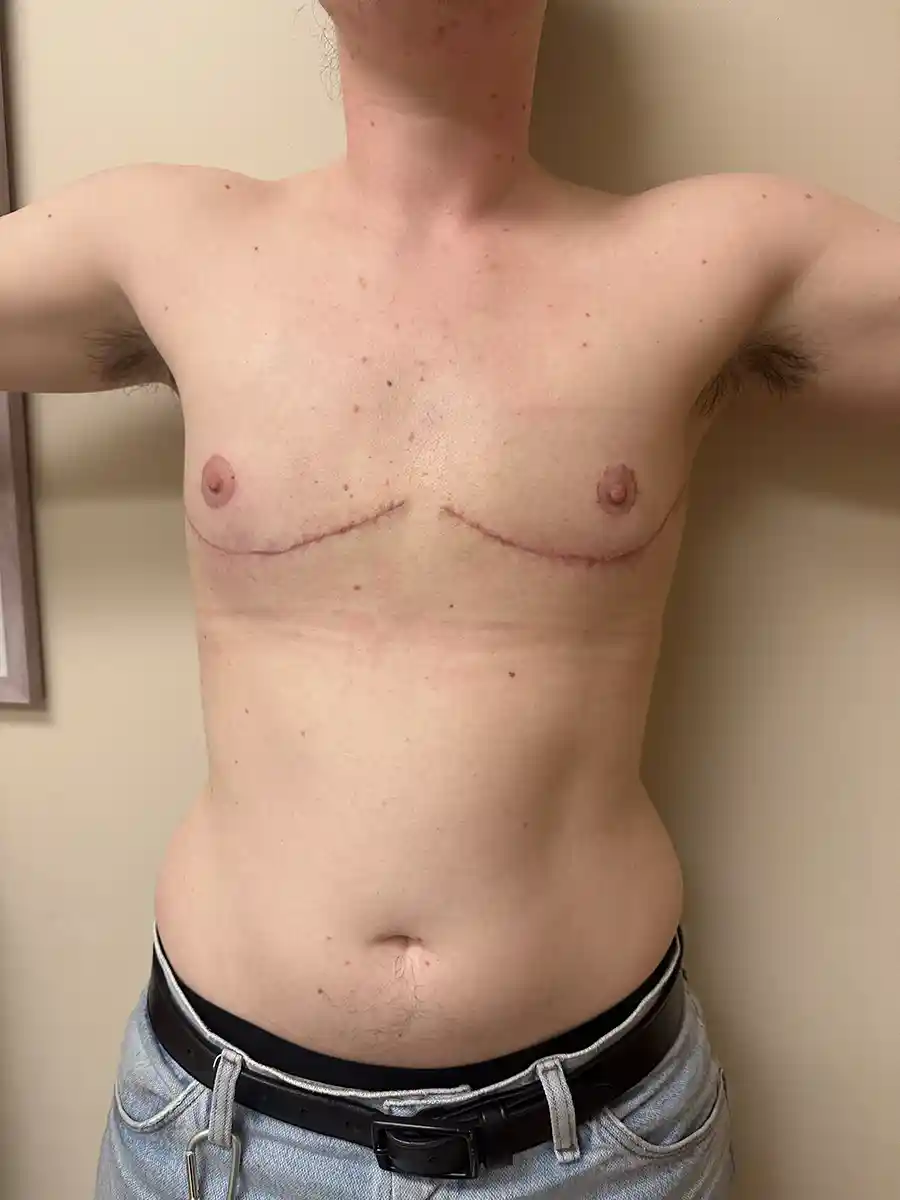 One month after top surgery. The patient has full arm movement and has returned to exercise. Sunscreen is recommended on scars for one year to optimize healing. Tattoos may be applied after three months, though one-year-old scars typically accept ink more easily.