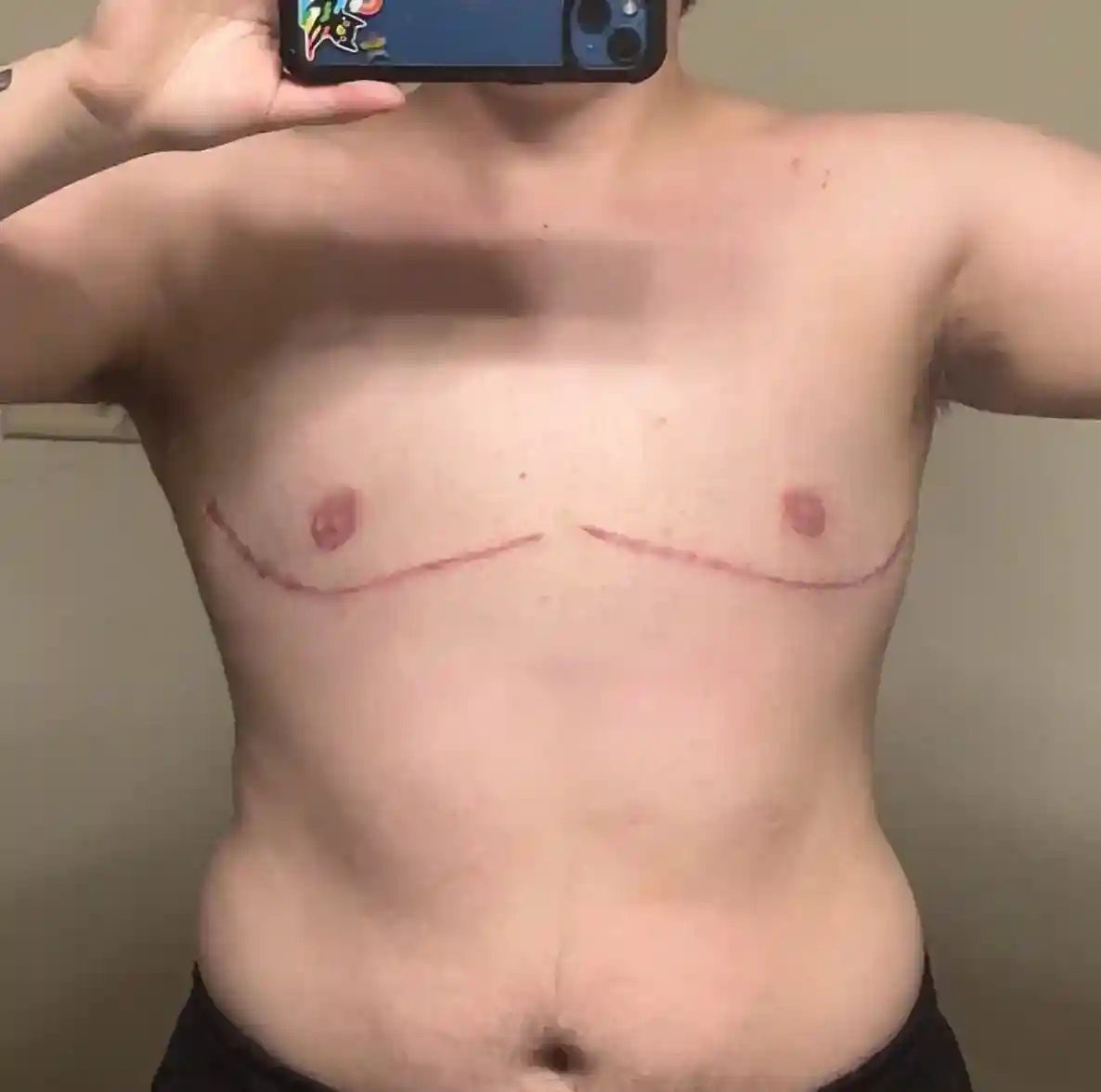 One month after double incision top surgery with free nipple grafting and minor chest liposuction. This non-binary patient sought the flattest possible chest and symmetric scars following the pectoral contour. The patient has full arm mobility and has returned to normal activity. Scars will continue to lighten. They are pleased with their flat areolae and well-projected nipples.