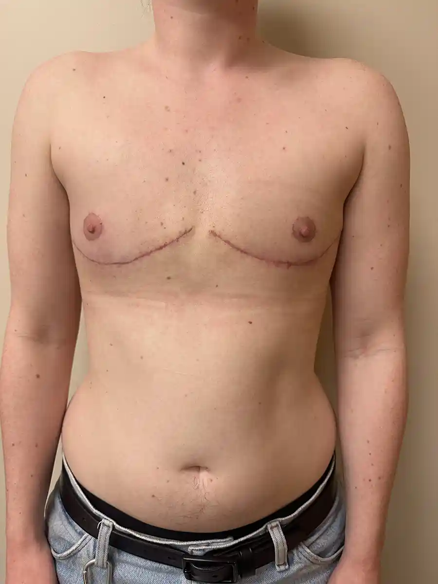 One month after buttonhole top surgery with Dr. Gunther. The patient prioritized nipple sensation while desiring a smaller chest size. They are very happy with their results, and scars will fade over time.