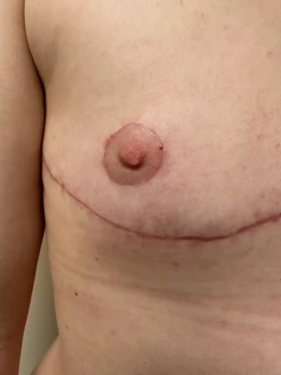 Close-up of the nipple one month after buttonhole surgery. The patient retains full sensation and is very happy with the masculine appearance and symmetry.
