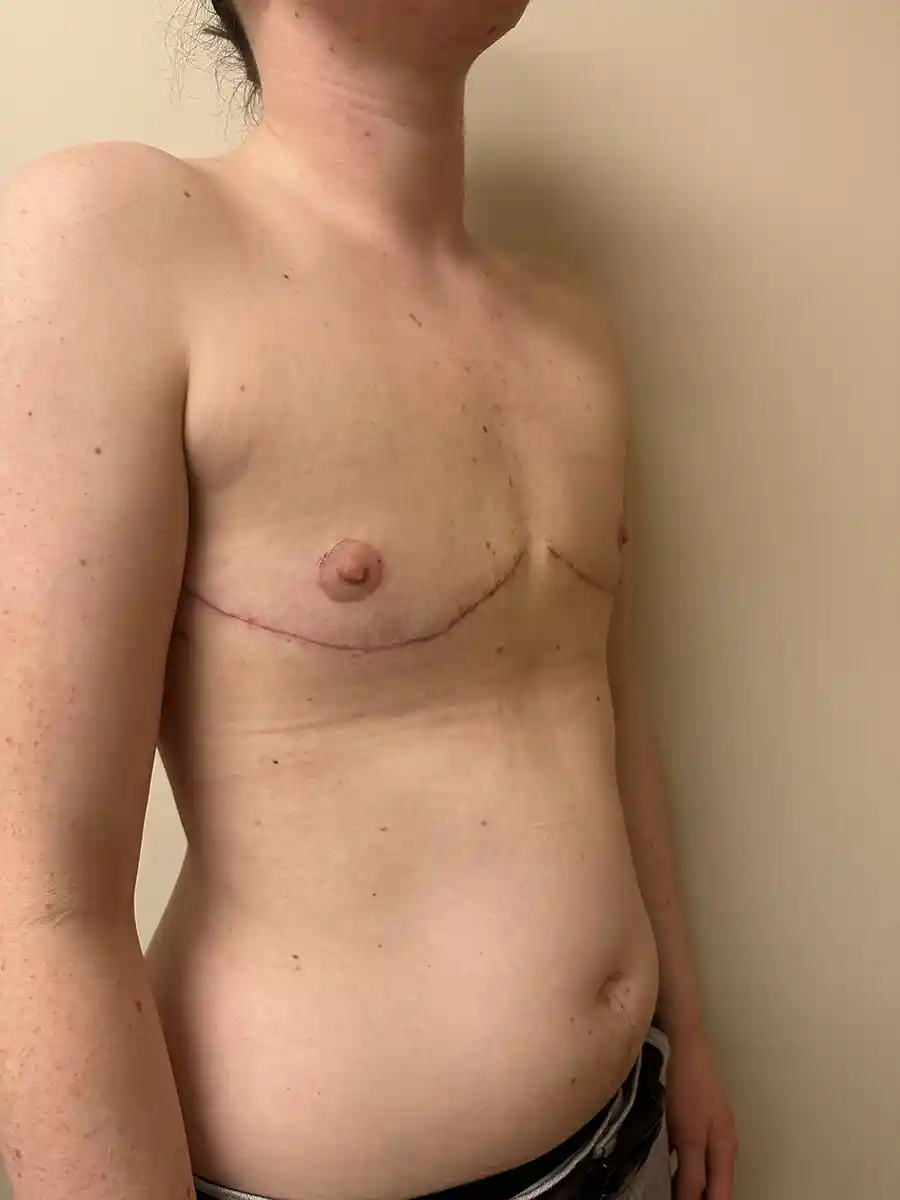 During buttonhole procedures, some chest tissue is preserved to maintain nipple sensation. This image demonstrates how flat the chest can appear while retaining sensation and natural contour.