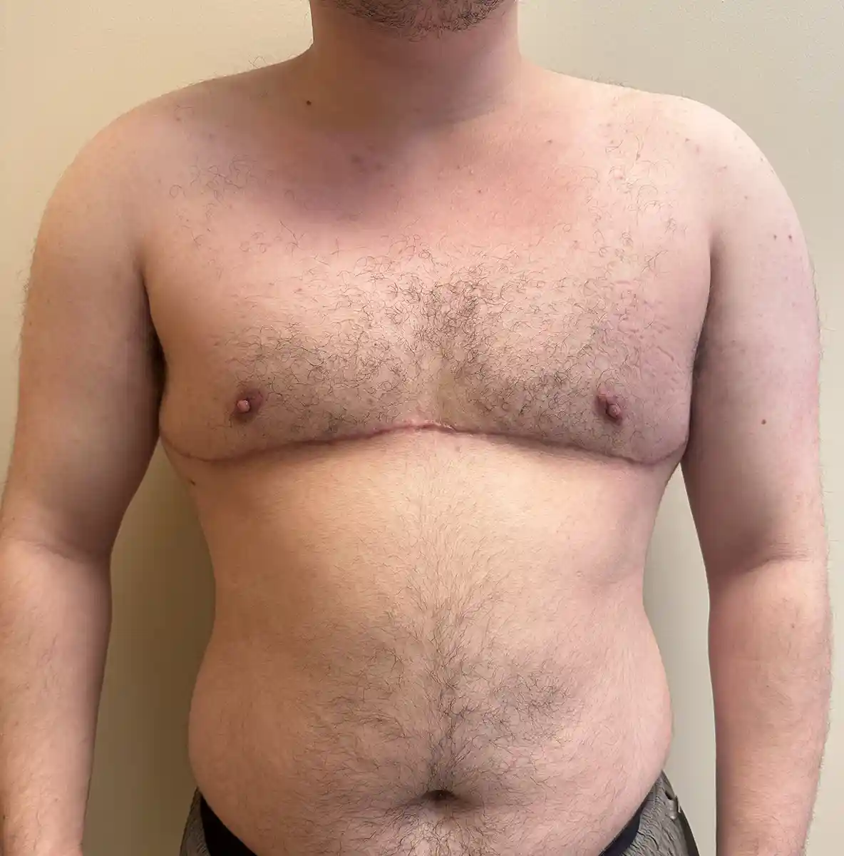 Three months after double incision top surgery with free nipple grafting. The patient requested straight incisions with a slight “J” curve at the edges. Incisions were designed to match their aesthetic goals. Scars will continue to fade, and the nipples healed with minimal scarring and strong projection.