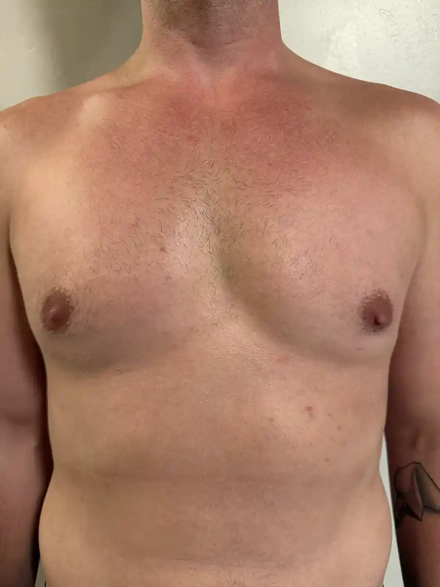 Nine months after keyhole top surgery. The incision is placed laterally at the nipple, allowing removal of all chest tissue through a small opening. The scar is nearly invisible even on close inspection. The patient reports a significant boost in confidence.