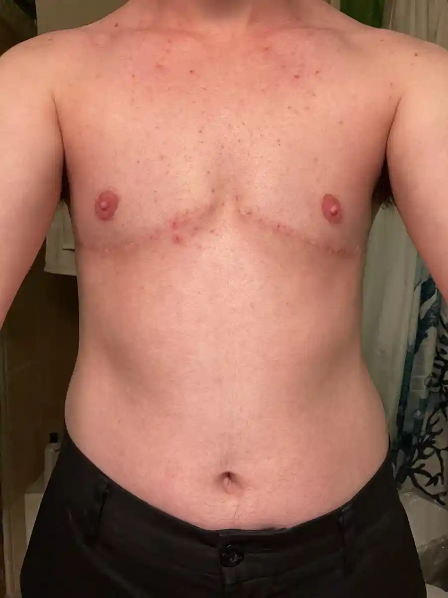 Six months after double incision top surgery with free nipple grafting. Scars are lightening and will continue to fade for up to 18 months. The patient reports nipple reactivity to temperature and gentle sensation. The nipples appear thin, natural, and integrated with the surrounding skin.