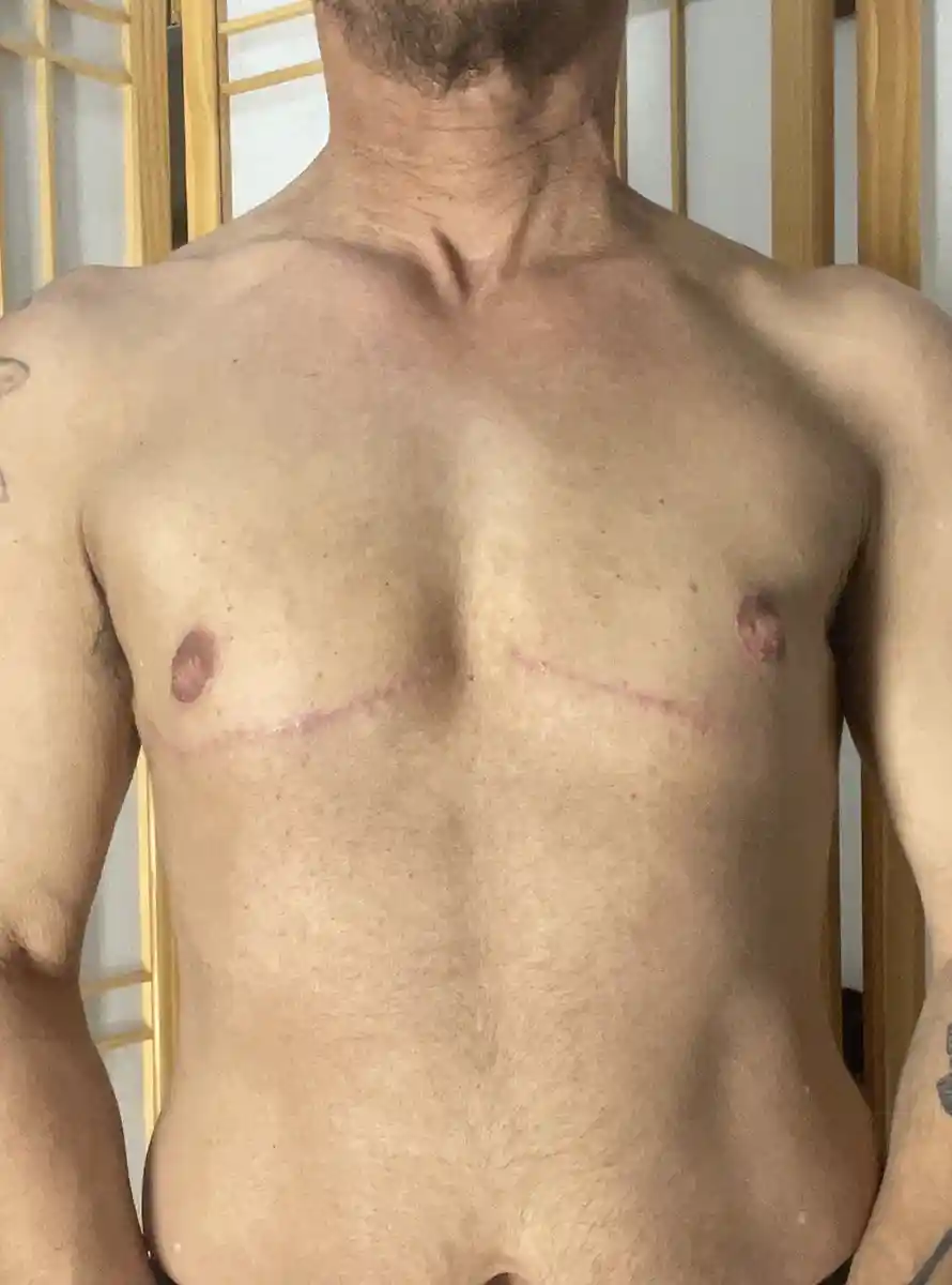 Six months after buttonhole top surgery with nipple reduction. The patient chose this technique to preserve nipple blood supply and sensation. A small amount of tissue remains for sensory function, but the chest appears flat and masculine. Scars follow the pectoral contour and will continue to lighten over 12–18 months.