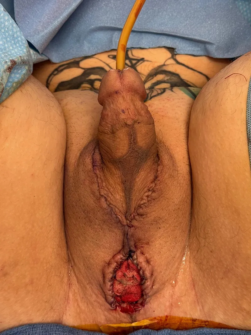 Penile-preserving vaginoplasty with Dr. Bowers.