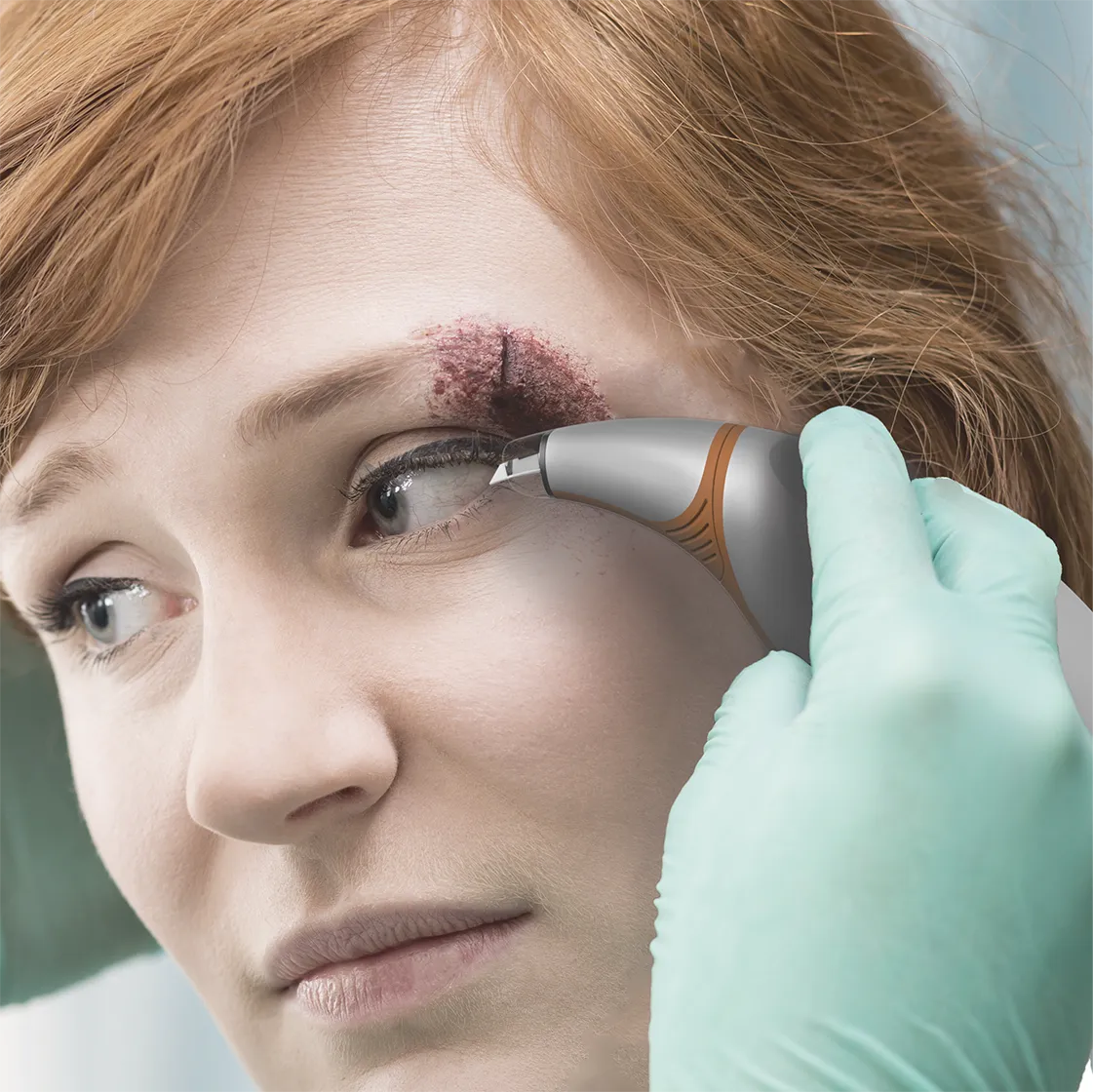 Close-up of a woman with a skin lesion near her eyebrow undergoing treatment with a handheld dermatology device held by a gloved hand.
