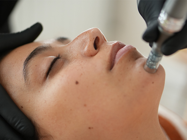 Vrouw ondergaat microneedling behandeling op kin met een apparaat door handschoenen dragende specialist.