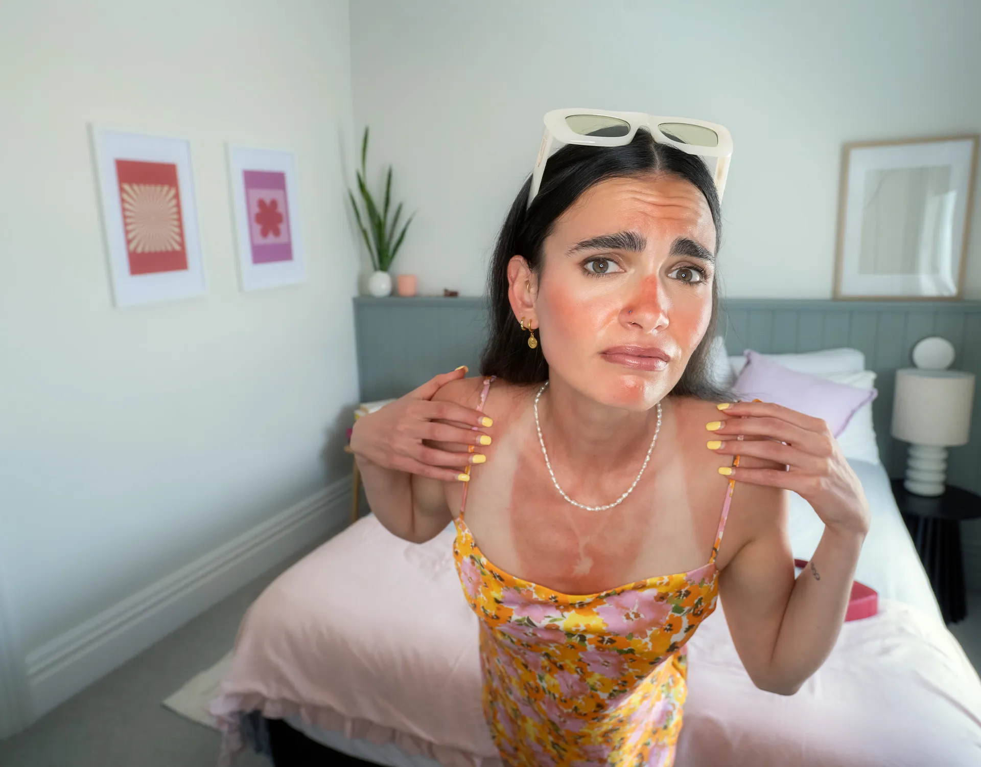 Woman with sunburned shoulders and chest, looking worried, wearing a floral dress and sunglasses on her head in a bedroom.