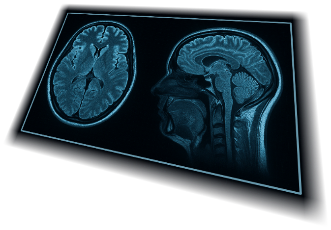 MRI brain scan
