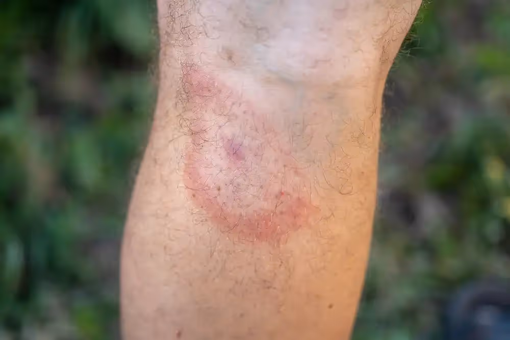 Circular red rash on a person’s leg, resembling a bullseye pattern commonly associated with a tick bite.
