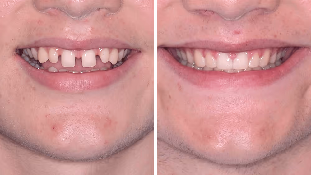 Close-up comparison of a smiling woman's mouth before and after dental treatment showing whiter, evenly shaped teeth.