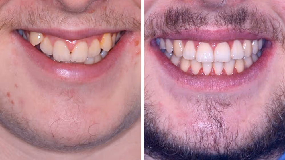 Close-up comparison of a person's smile showing crooked, spaced teeth on the left and straightened teeth on the right.