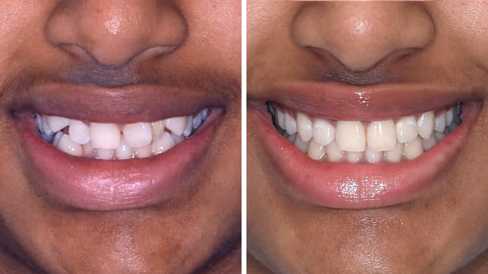 Close-up comparison of a person's smile before and after dental treatment showing whiter, straighter teeth on the right.