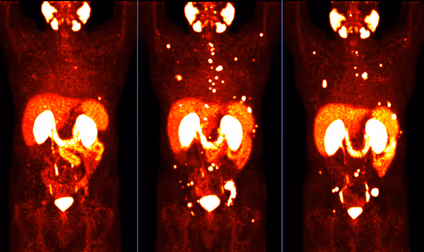 PSMA PET/CT RIGHT: Baseline (screening) PET/CT prior to initiation of therapy showing bone and lymph node metastases. PSMA PET/CT CENTER: Tumor progression under Radium-223 and hormone therapy. PSMA PET/CT LEFT: Near-complete remission already after 3 cycles of ¹⁷⁷Lu PSMA therapy.