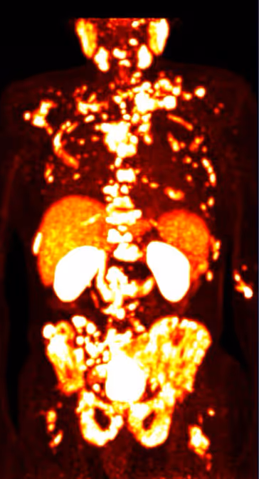 In cases of already extensive, generalized metastatic disease prior to the start of therapy, only a limited treatment response can be expected (PSA tumor marker: 1523 ng/mL).