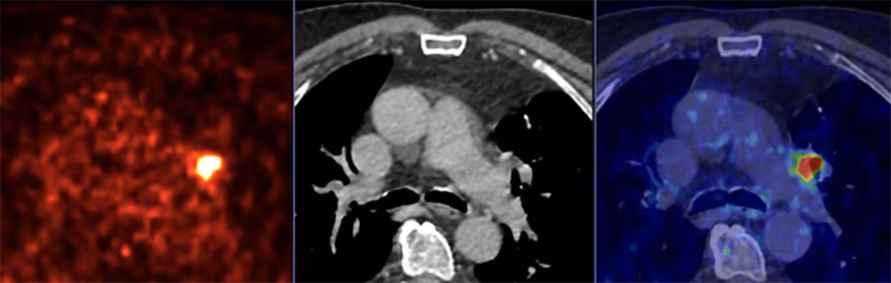 Lymphknoten-Metastasen am linken Lungen-Hilus im Thorax (PSA Tumormarker 32 ng/ml)