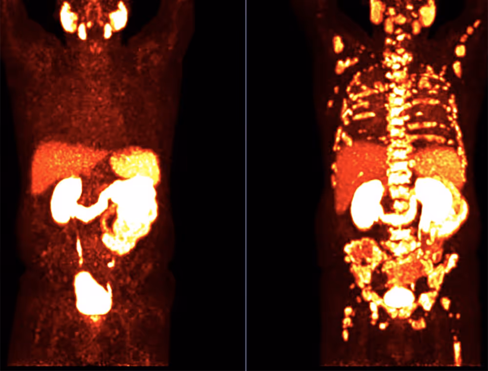 PSMA PET/CT RECHTS: Massive generalisierte Metastasierung bereits zum Zeitpunkt der Erstdiagnose (Screening PSA über 1053 ng/ml). PSMA PET/CT LINKS: Nahezu vollständige Remission nach 6 Zyklen 177 LU PSMA Therapie (PSA Tumormarker Abfall auf 3,0 ng/ml).