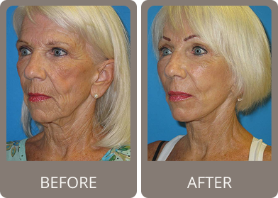 Side-by-side before and after photos of an older woman showing smoother skin and reduced wrinkles on her face and neck after treatment.