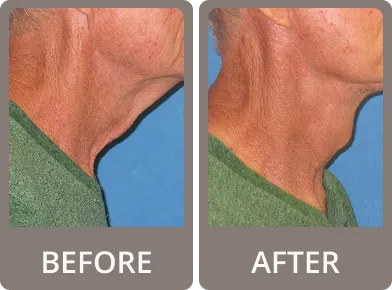 Side-by-side comparison of a man's neck before and after a skin tightening treatment showing reduced sagging and smoother skin in the after image.