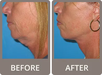 Side-by-side before and after images showing a woman's lower face and neck; the before image shows sagging skin under the chin, while the after image shows a tighter, smoother neck contour.