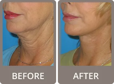 Side-by-side comparison of a woman's lower face and neck before and after a cosmetic treatment showing reduced neck wrinkles and tighter skin.