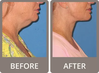 Side-by-side comparison of a woman before and after treatment, showing tightened and smoother skin under the chin and neck.