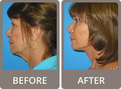 Side-by-side profile comparison of a woman before and after a cosmetic neck and jawline procedure, showing a smoother jawline and reduced neck sagging.