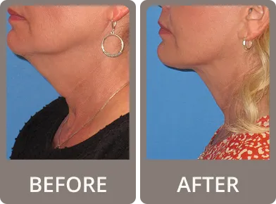 Side-by-side comparison of a woman's neck and jawline before and after a cosmetic procedure, showing a tighter and smoother neck contour in the after image.