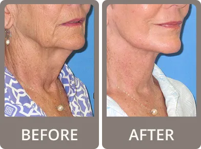 Side-by-side before and after photos of an older woman’s neck and jawline, showing reduced wrinkles and tighter skin in the after image.