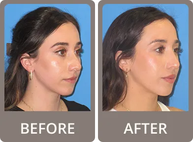 Side-by-side before and after photos of a woman showing profile changes in nose shape after rhinoplasty.