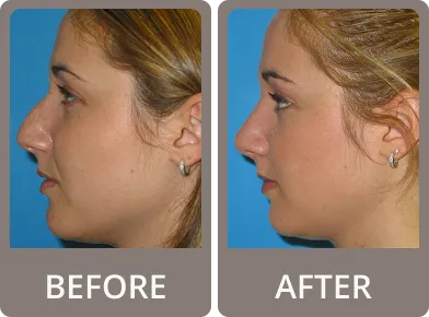 Side-by-side profile photos of a woman showing before and after rhinoplasty, with a straighter nose and refined nasal tip after surgery.