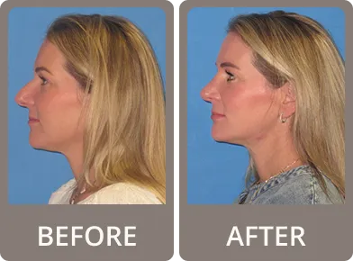 Side-by-side profile images of a blonde woman before and after rhinoplasty, showing a smoother and more refined nose shape in the after photo.