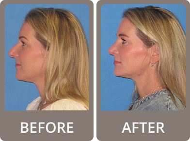 Side-by-side profile images of a blonde woman before and after rhinoplasty, showing a smoother and more refined nose shape in the after photo.