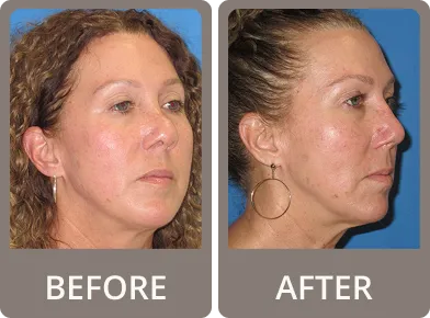 Side-by-side before and after images of a woman showing changes in her nose shape after rhinoplasty.