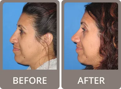 Side-by-side comparison of a woman's profile before and after rhinoplasty, showing a smoother, more refined nose shape after surgery.