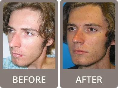 Side-by-side before and after photos of a young man showing facial improvements, including reduced acne and a more defined jawline.