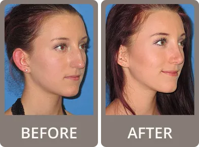 Side-by-side before and after photos of a woman showing facial profile changes after rhinoplasty.