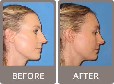 Side-by-side profile photos of a woman labeled before and after rhinoplasty showing a more refined nose shape post-surgery.