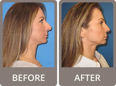 Side-by-side before and after photos of a woman showing a rhinoplasty nose reshaping result, with a straighter nose profile after surgery.